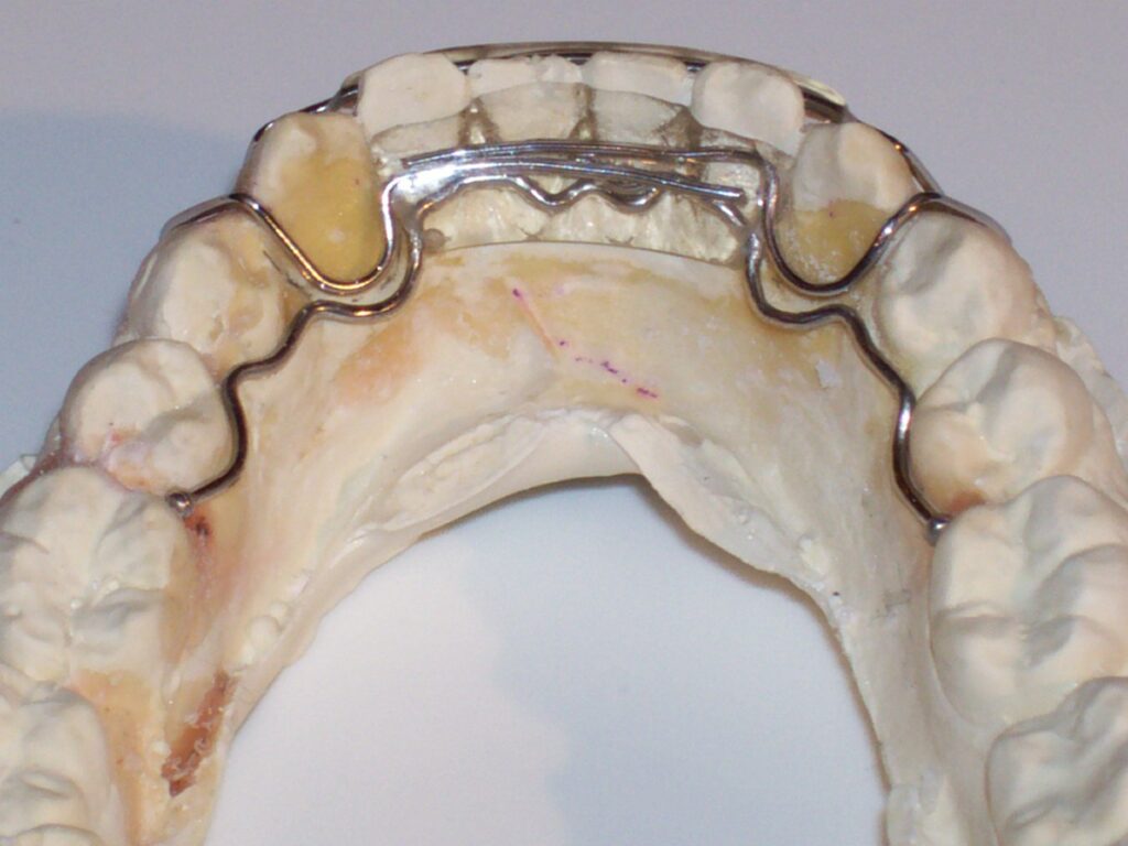3-3 Clip-on Spring retainer, shown with optional wire extensions