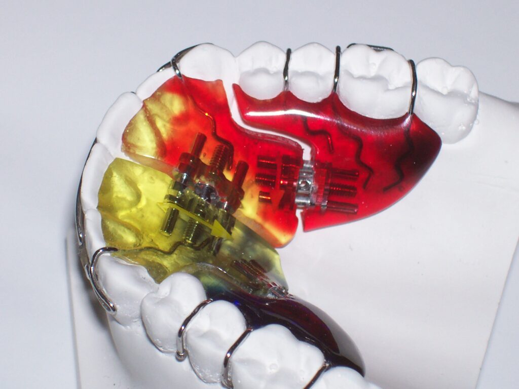 Sagittal removable dental expander