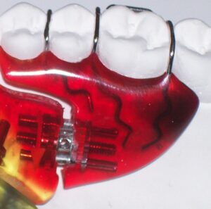 Orthodontic Sagittal Removable Expander Posterior Screw Adams and Ball Clasps