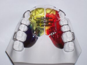 Orthodontic Removable 3 Way Expander with Ricketts Labial Bow, Adams & Ball Clasps