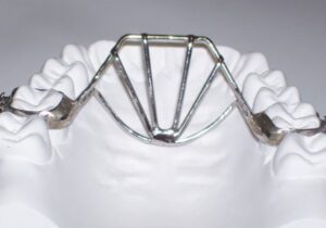Fixed orthodontic tongue thrust & thumb sucking habit breaker