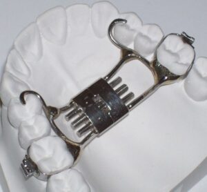Orthodontic Hyrax Rapid Palatal Expander with Occlusal Rests