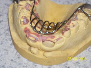Fixed orthodontic thumb sucking habit breaker