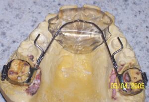 Fixed anterior bite plate with bondable rests
