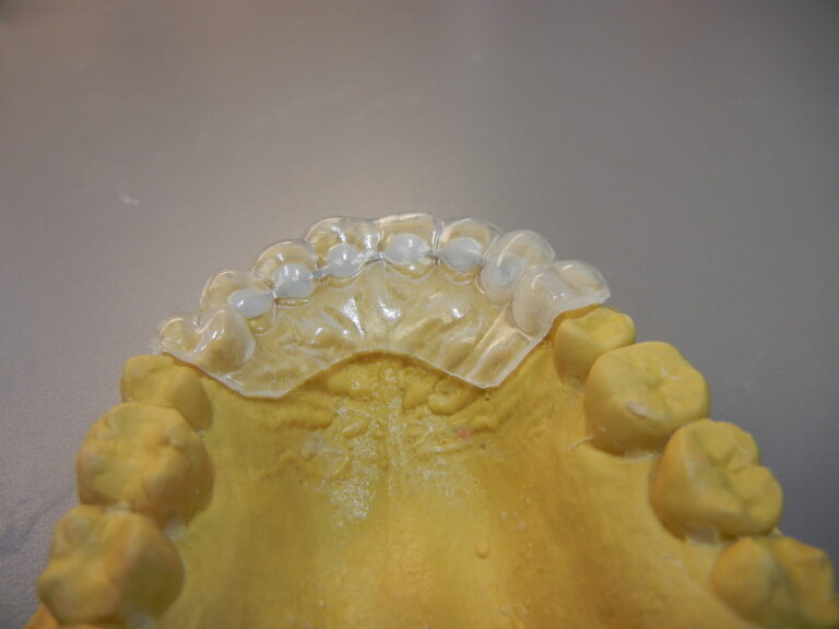 Fixed Lingual Retainer with placement matrix - Fox Valley Orthodontic Laboratory