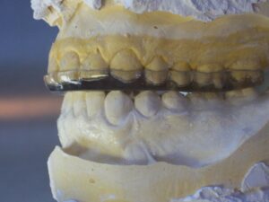 flat plain occlusal splint
