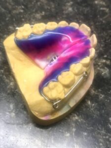 Orthodontic Transverse Removable Expander with Buccal Tube Clasps