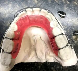 NiTi dental spring aligner
