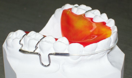 Circumferential retainer soldered to adams claps.  (Shown with invisible labial bow)