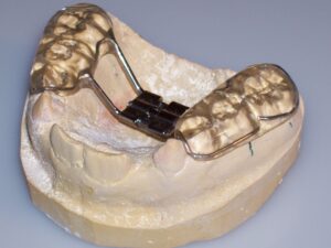 Orthodontic Bonded Rapid Palatal Expander (RPE) with Acrylic Posterior Occlusal Pads