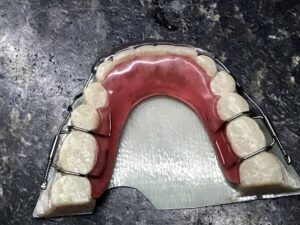 NiTi dental spring aligner