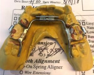 Orthodontic Lower Hyrax Expander