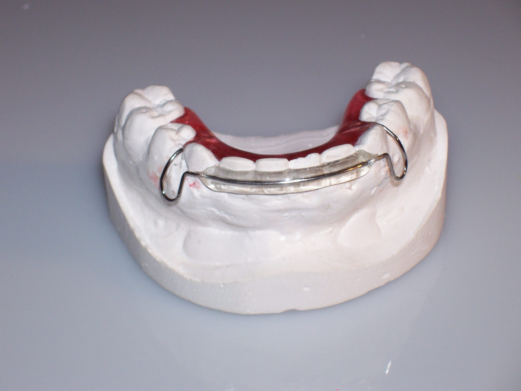 Dental Spring Retainers And Aligners For Minor Tooth Movement