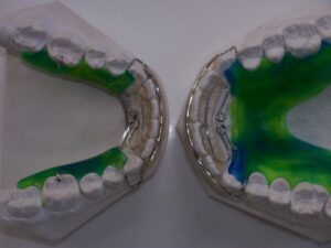 Super Spring Retainers - Fox Valley Orthodontic Laboratory