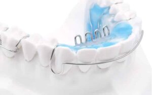 Orthodontic Hawley retainer with tongue crib habit breaker