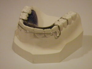 Hawley Retainer - Fox Valley Orthodontic Laboratory