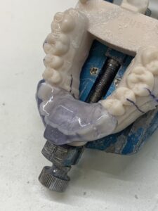 NTI-TSS (Nociceptive Trigeminal Inhibition – Tension Suppression System)